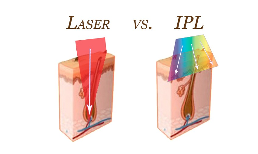 diode laser vs IPL hair removal comparison